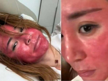 Mặt sưng đỏ, biến dạng sau 22 năm không tẩy trang