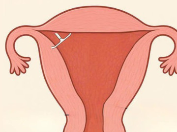 Vòng tránh thai "đi lạc", cắm sâu vào cơ tử cung người phụ nữ sau 5 năm sử dụng