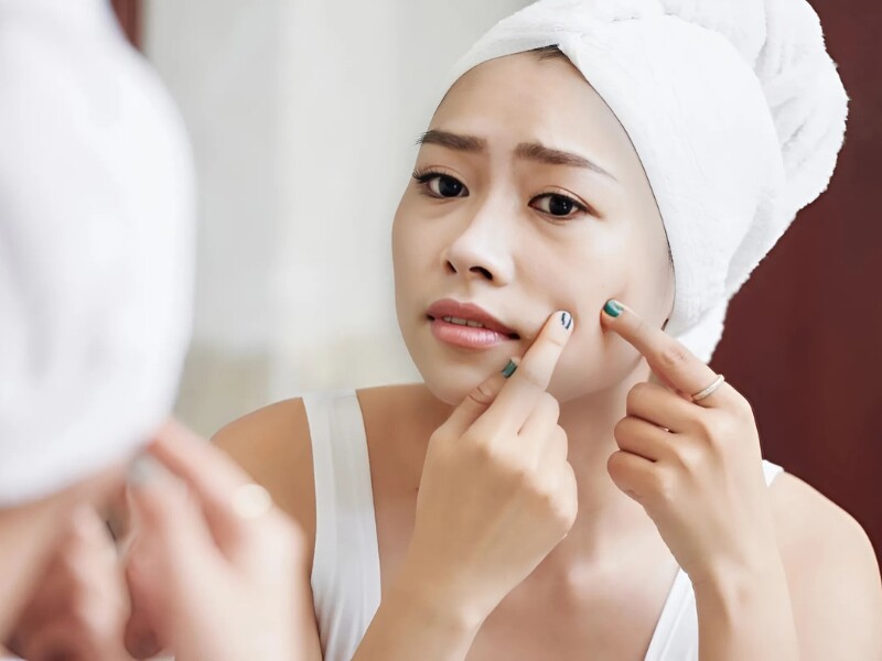 Nặn mụn bằng tay không sạch hoặc dụng cụ không vô trùng còn làm tổn thương da, để lại sẹo, vết thâm, thậm chí nhiễm trùng nặng. Thói quen này còn khiến tình trạng da xấu đi, tạo cảm giác bất an và giảm tự tin. 