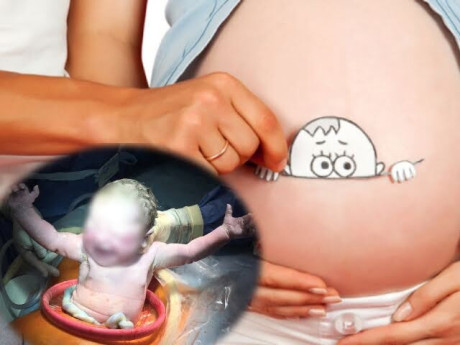 Mẹ bầu sinh mổ vẫn có thể cho con trải nghiệm gần như sinh thường nhờ phương pháp sinh kiểu mới