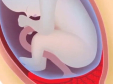 Ngoạn mục cứu sống bé trai bị dây rau chèn ép, mẹ phải cắt tử cung