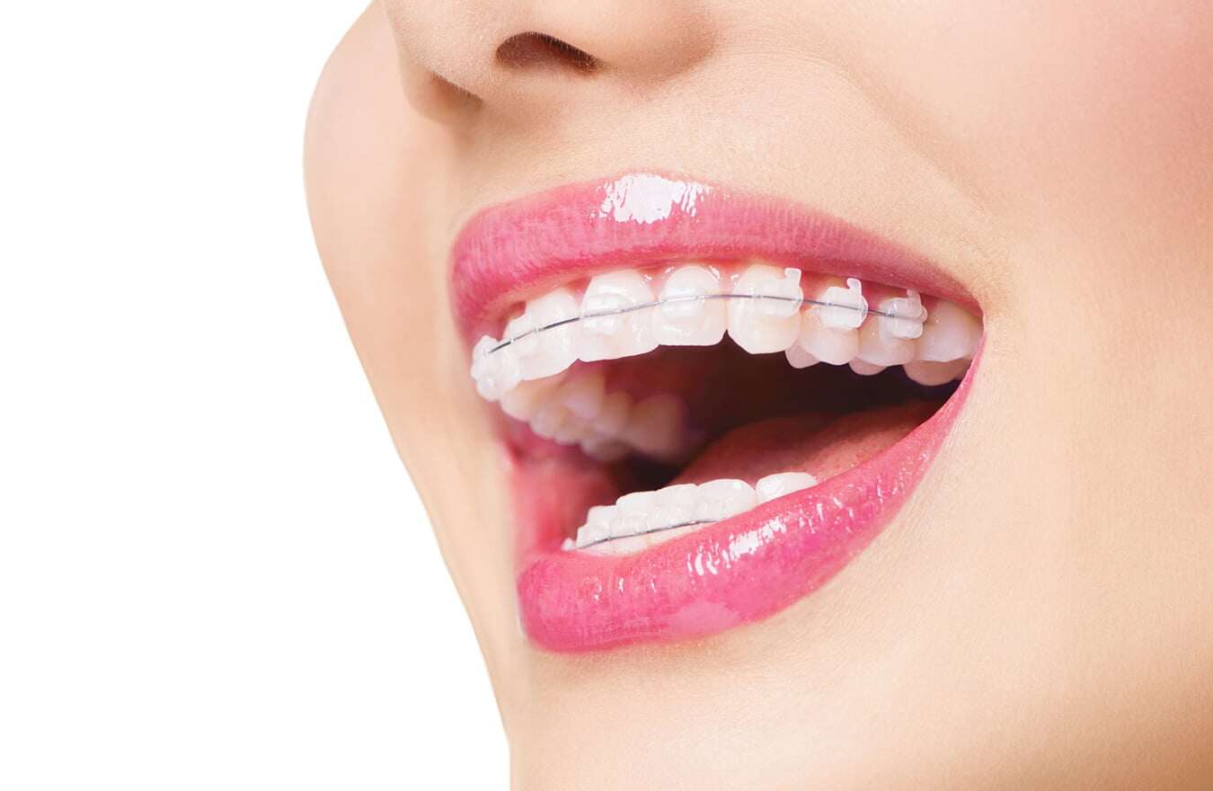 Phương Pháp Làm Đẹp Được Công Khai Ở Các Cuộc Thi Nhan Sắc, Hầu Như Ai Ứng Dụng Cũng Đều Đăng Quang! 1 Niềng Răng Ngày Càng Trở Thành Một Trong Những Bí Quyết Làm Đẹp Được Nhiều Người Nổi Tiếng Và Các Nàng Hậu Việt Nam Lựa Chọn Để Cải Thiện Ngoại Hình.