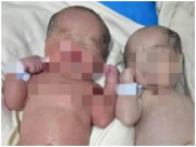 Bà bầu - Người mẹ vừa sinh đôi nhưng hai con khác nhau: Bé da đỏ au, bé thì trắng bệch