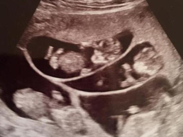 Đi tiêm kích trứng, người phụ nữ bất ngờ biết mình đang mang thai 9 con