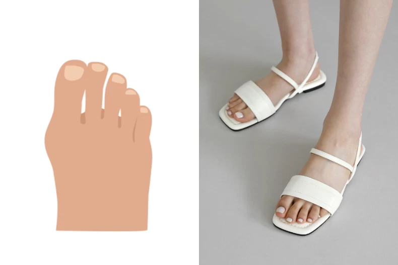 Bàn chân với Hallux Valgus rất dễ gây đau nếu chị em chọn sai kiểu giày
