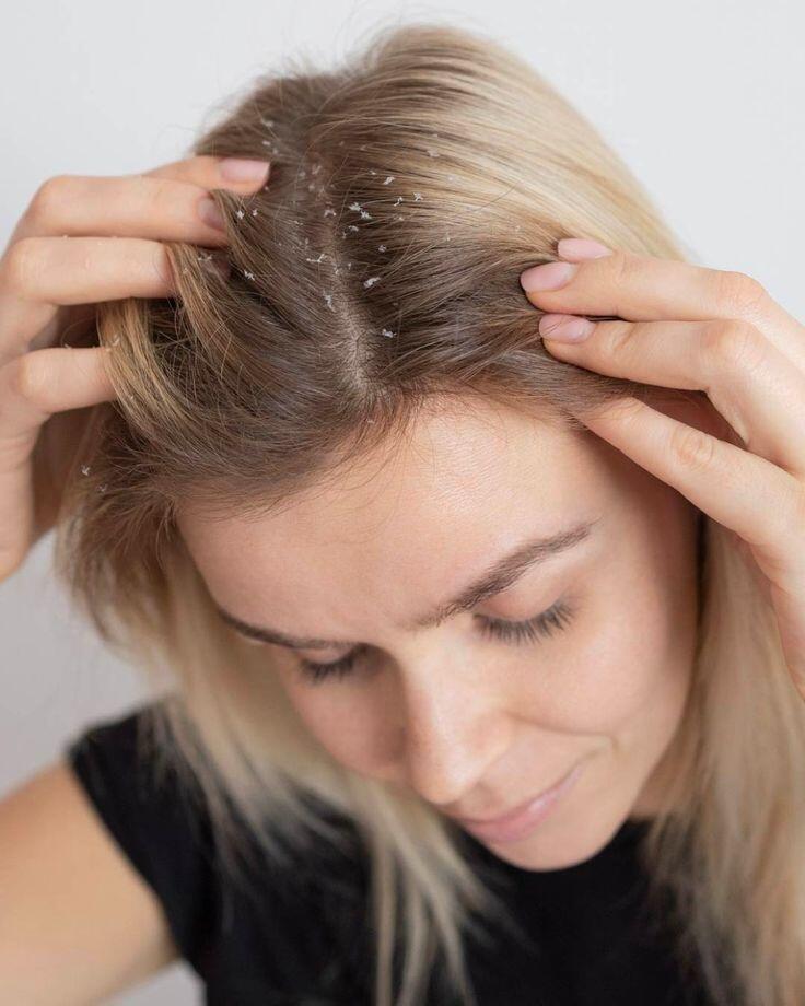 Ngoài ra, oxy già còn có thể gây đau rát nếu trên da đầu có vết thương hở 