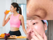 Đẹp - Muốn trị dứt điểm mụn đầu đen? Tránh xa 3 thực phẩm này nếu không muốn công sức skincare đổ sông đổ biển