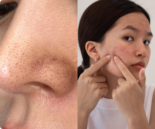 Mụn đầu đen và lỗ chân lông to là nỗi ám ảnh của chị em ngày hè.