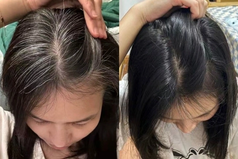 Một lối sống lành mạnh, ít căng thẳng sẽ giúp giảm tình trạng bạc tóc.