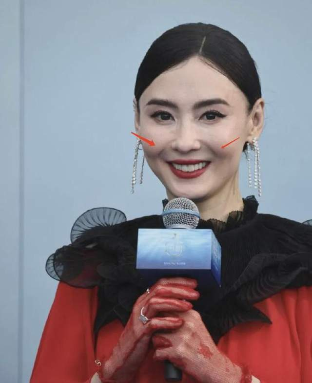 Trong một sự kiện khác trước đó, gò má của Trương Bá Chi nổi rõ, đặc biệt khi cười nhưng tổng thể cơ mặt lại có phần đơ cứng, càng củng cố thêm những đồn đoán về dấu vết thẩm mỹ.