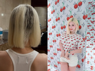 DJ Hàn trụi cả mảng tóc vì sự cố làm đẹp