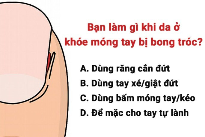 Hành Động Khi Da Khóe Móng Tay Bong Tróc Bạn Sẽ Làm Gì?