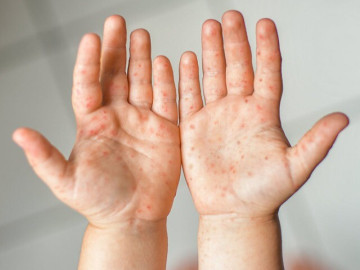 Ca tay chân miệng tại TP HCM tăng cao