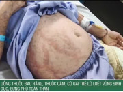 Clip Eva - Uống thuốc đau răng, thuốc cảm, cô gái trẻ lở loét vùng sinh dục, sưng phù toàn thân