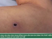 Clip Eva - Kinh hãi hình ảnh giun rồng chui lên qua da, phát hiện nhiều ổ giun áp xe khắp cơ thể