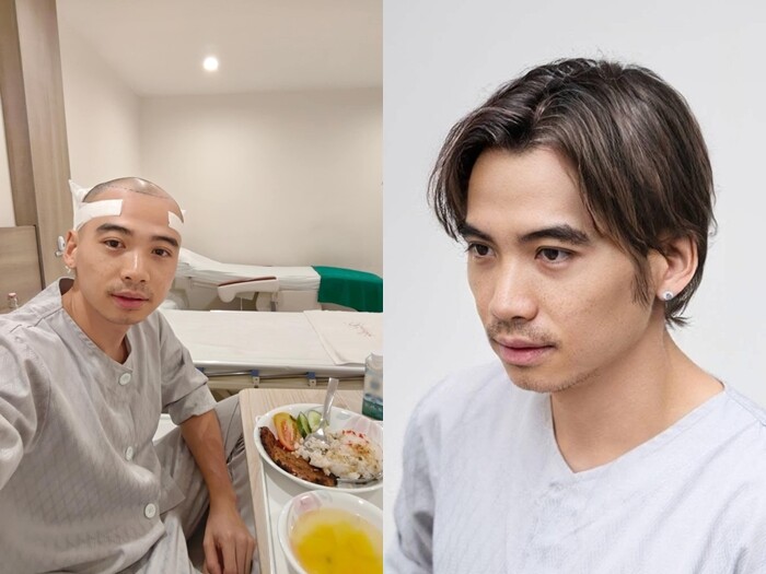 Chồng HHen Niê cấy tóc để có ngoại hình đẹp hơn.
