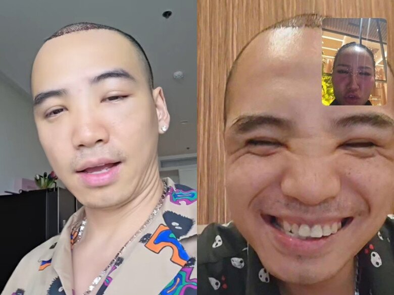 Nhiều người bất ngờ trước khuôn mặt khác lạ của Tuấn Khôi sau khi cấy tóc.