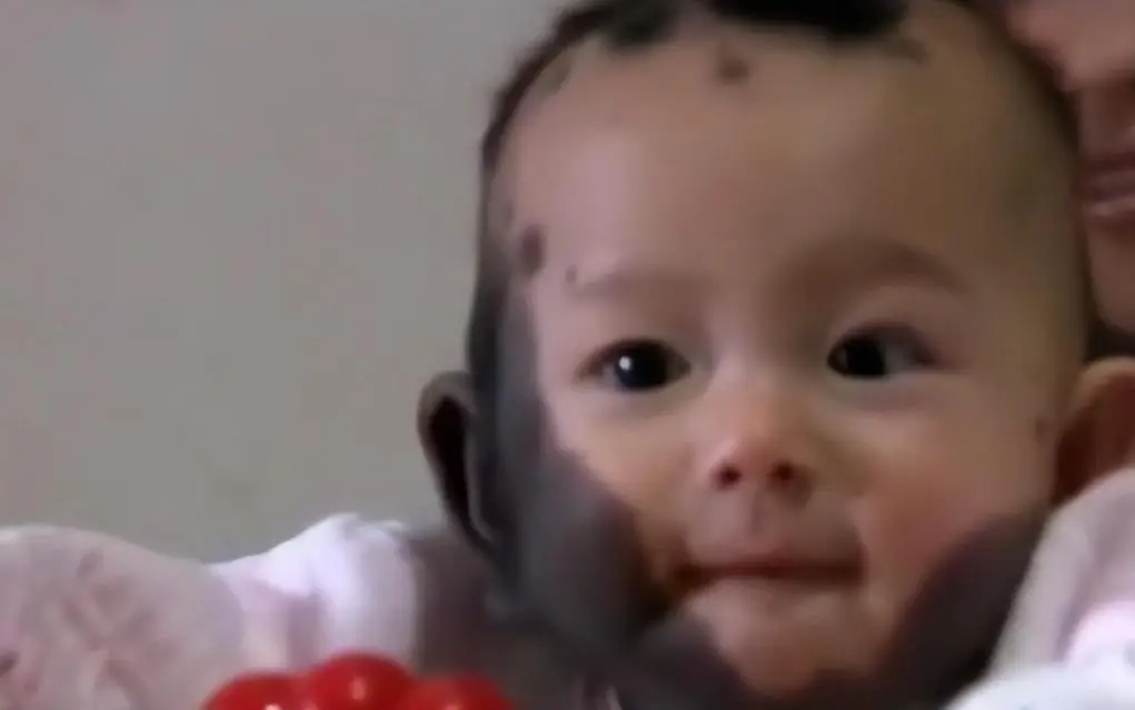 Đứa bé chào đời với một mảng đen lớn chạy dài khắp cơ thể. Các bác sĩ, dù đã có nhiều năm kinh nghiệm, cũng không thể xác định chính xác nguyên nhân.