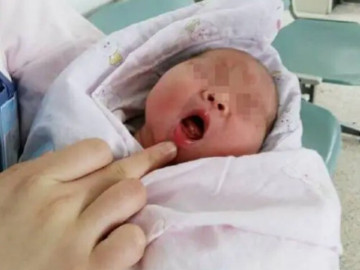 Bé sơ sinh vừa chào đời đã có răng, cả khoa hội chẩn: "Phải nhanh lấy nó ra!"