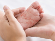 Sức khỏe - Hà Nội: Số ca mắc sởi vẫn tiếp tục gia tăng, đã ghi nhận 2 ca tử vong trong đó có cả người lớn