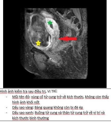 Người phụ nữ ở Hà Nội mắc ung thư giai đoạn cuối nhưng kiên trì làm một việc, sau 4 tháng khối u biến mất hoàn toàn - 2