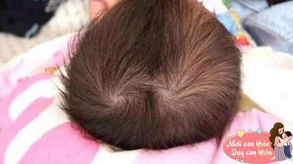 Nhiều trẻ có 2 hoặc 3 xoáy tóc.