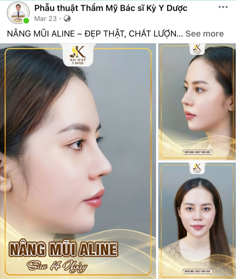 Dáng mũi Aline chuẩn từng milimet từ bác sĩ Kỳ Y Dược - 3