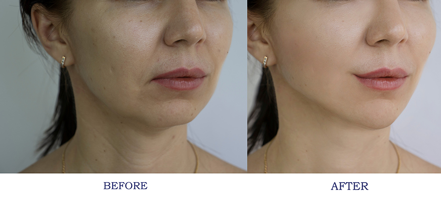 A person receiving a cosmetic treatment.