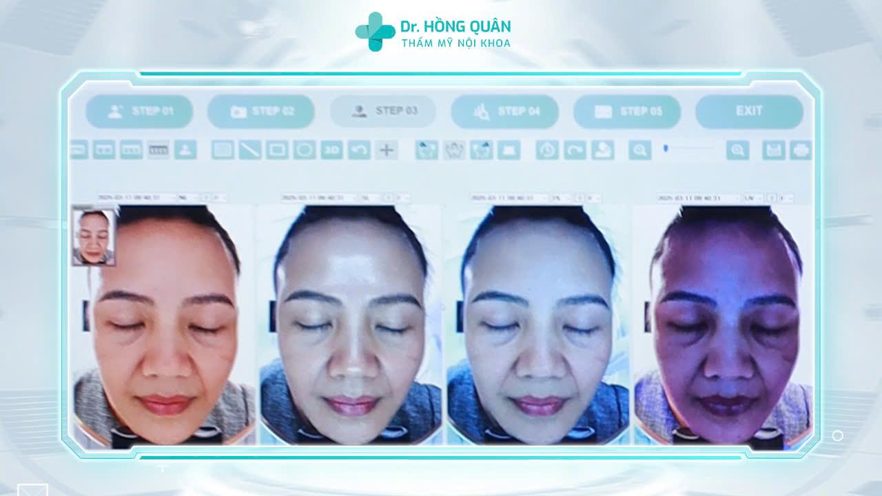 Khách hàng được thăm khám, soi da bằng máy móc, thiết bị hiện đại để xác định chính xác vị trí bị thiếu hụt collagen, từ đó bác sĩ Quân lên phác đồ điều trị phù hợp