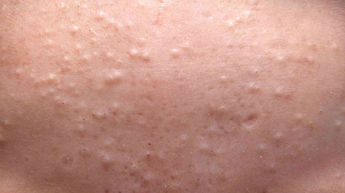 Lưu ý giúp khắc phục mụn ẩn đúng cách