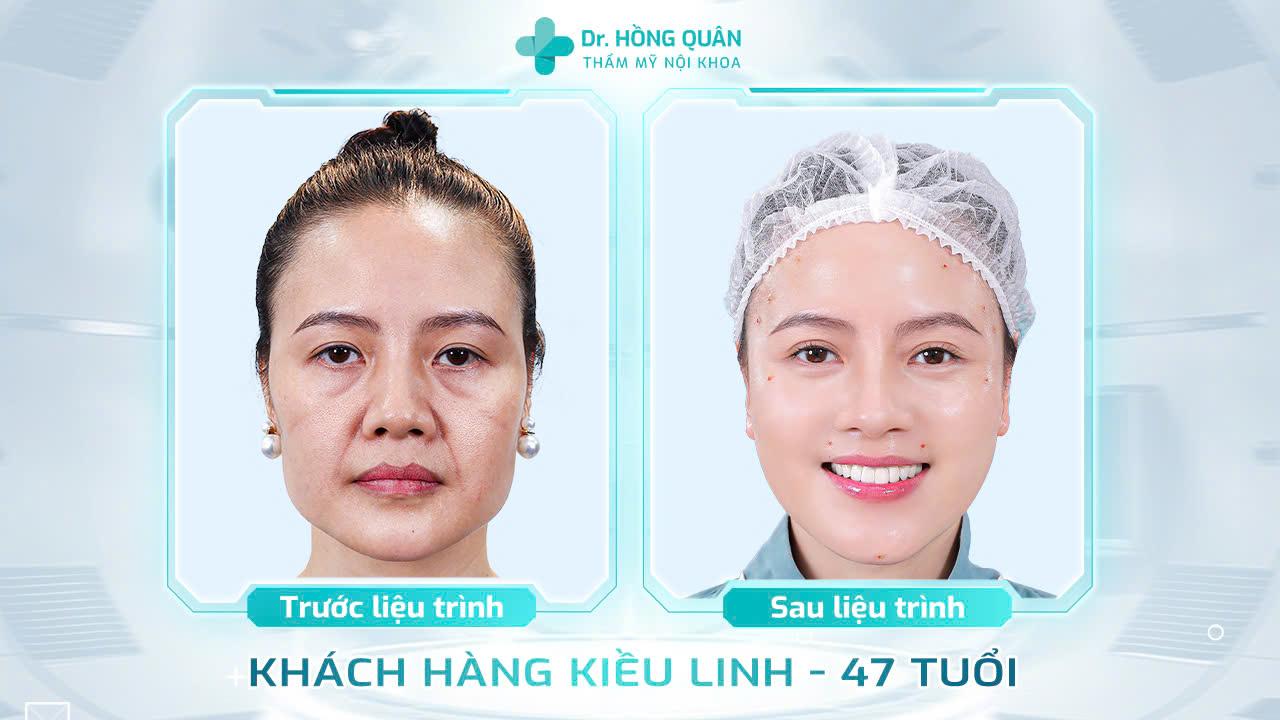 Hầu hết các khách hàng sau khi được Bác sĩ Quân thăm khám và điều trị đều hoàn toàn hài lòng về kết quả, sự tận tâm và chuyên nghiệp trong từng quy trình
