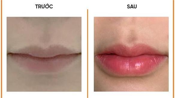 Filler Hàn Quốc có ưu điểm vượt trội gì? - 3