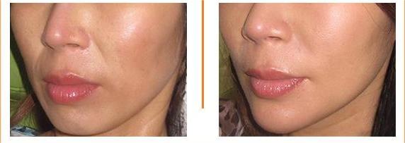Filler Hàn Quốc có ưu điểm vượt trội gì? - 4