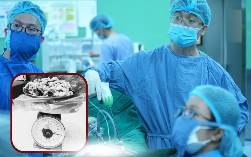 3 tiếng phẫu thuật bóc khối u xơ tử cung nặng hơn 1.4kg.