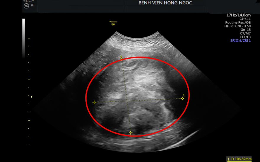 Khối u kích thước hơn 10cm cắm sâu trong cơ tử cung.