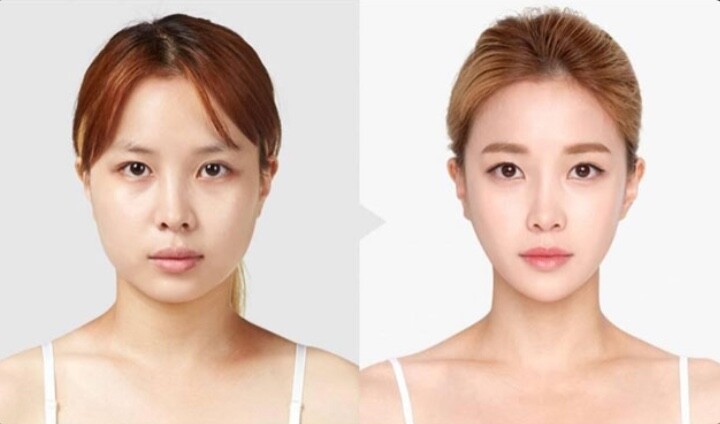 Tiêm filler được yêu thích bởi đây là phương pháp có kết quả tức thì, ít xâm lấn, không đụng dao kéo quá nhiều và thời gian hồi phục nhanh 