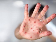 Sức khỏe - Cứu sống bé gái ở Hà Nội mắc căn bệnh không thuốc chữa nhưng rất hay gặp ở trẻ nhỏ