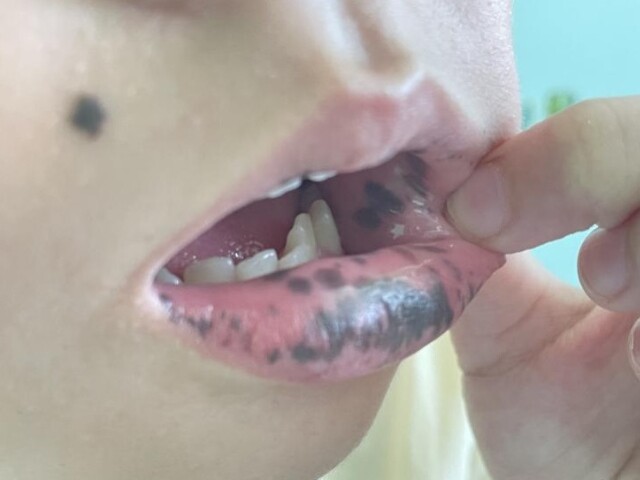 Mẹ phát hiện môi con gái 10 tuổi có nhiều đốm đen kỳ lạ, đến bệnh viện kiểm tra thì kinh hãi nghe bác sĩ nói