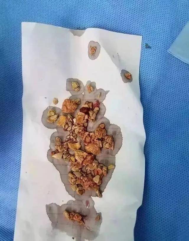 Bé 5 tháng tuổi không đi tiểu trong 20 giờ, bị sưng khắp người, bác sĩ phát hiện nguyên nhân đến từ bữa ăn hàng ngày - 2