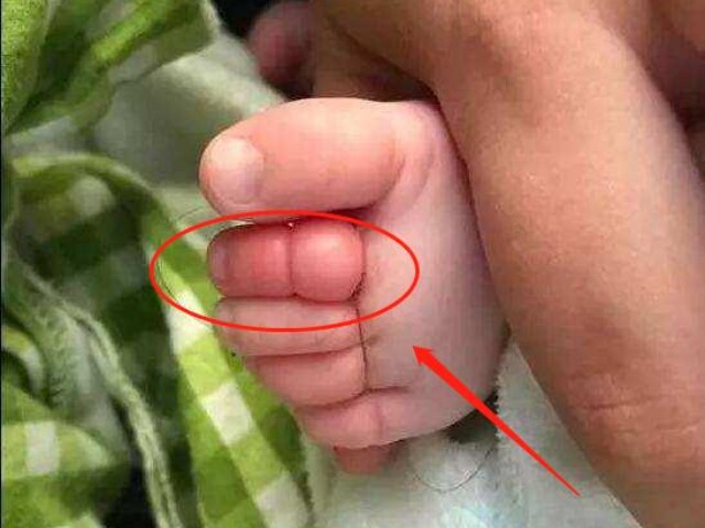 Bố đưa con 2 tuổi đi bơi, lúc về phát hiện ngón chân con phù lên đỏ tấy, đến bệnh viện bác sĩ báo tin sốc - 1