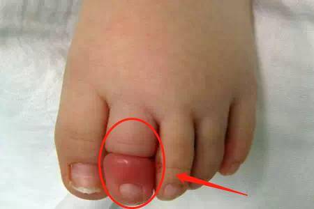 Bố đưa con 2 tuổi đi bơi, lúc về phát hiện ngón chân con phù lên đỏ tấy, đến bệnh viện bác sĩ báo tin sốc - 2