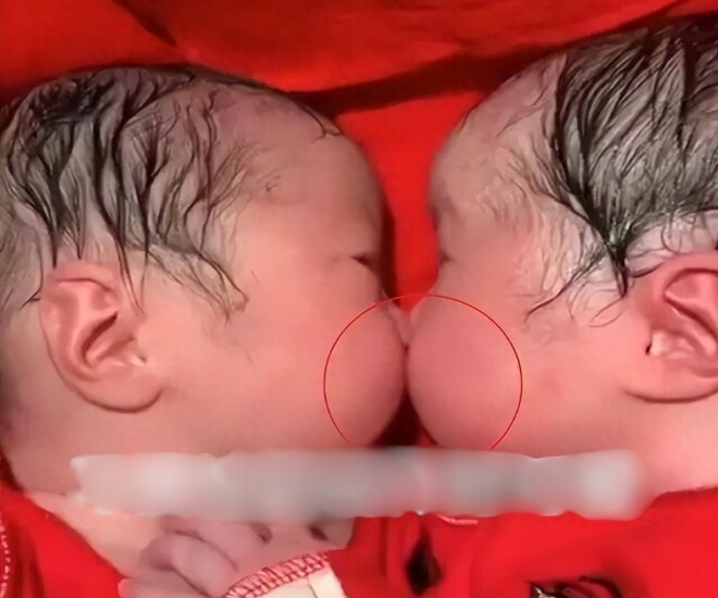 Cặp sinh đôi bám chặt lấy nhau khi mới chào đời, y tá không thể tách rời mà phải thốt lên: “Thật hiếm gặp” - 1