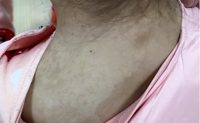 Con gái 5 tuổi có nhiều đốm nâu trên lưng, mẹ tưởng là tàn nhang nhưng đến bệnh viện bác sĩ đưa ra kết luận sốc - 2