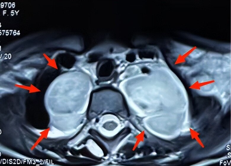 Con gái 5 tuổi có nhiều đốm nâu trên lưng, mẹ tưởng là tàn nhang nhưng đến bệnh viện bác sĩ đưa ra kết luận sốc - 4
