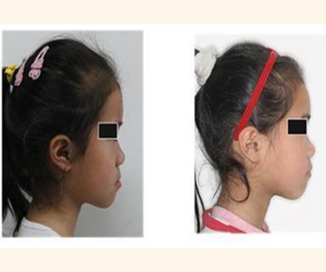 Con gái lúc nhỏ đẹp nhưng càng lớn càng móm, đến bệnh viện bác sĩ nói nguyên nhân khiến gia đình suy sụp - 1