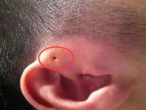 Mẹ phát hiện gần tai con xuất hiện một lỗ sâu khác thường liền tò mò bóp thử, không ngờ bác sĩ yêu cầu phẫu thuật ngay