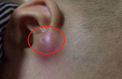 Mẹ phát hiện gần tai con xuất hiện một lỗ sâu khác thường liền tò mò bóp thử, không ngờ bác sĩ yêu cầu phẫu thuật ngay - 2