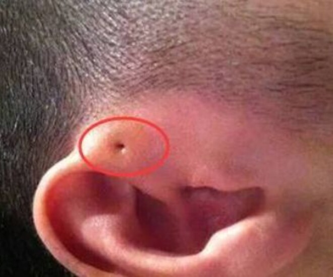 Mẹ phát hiện gần tai con xuất hiện một lỗ sâu khác thường liền tò mò bóp thử, không ngờ bác sĩ yêu cầu phẫu thuật ngay - 1