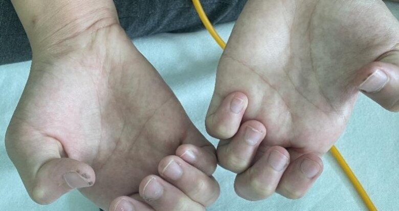Mẹ phát hiện môi con gái 10 tuổi có nhiều đốm đen kỳ lạ, đến bệnh viện kiểm tra thì kinh hãi nghe bác sĩ nói - 2
