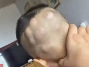 Yêu con - Con đi chơi về mẹ phát hiện đầu bé mọc nhiều khối u lớn như hạt óc chó, đến bệnh viện khám liền thất kinh